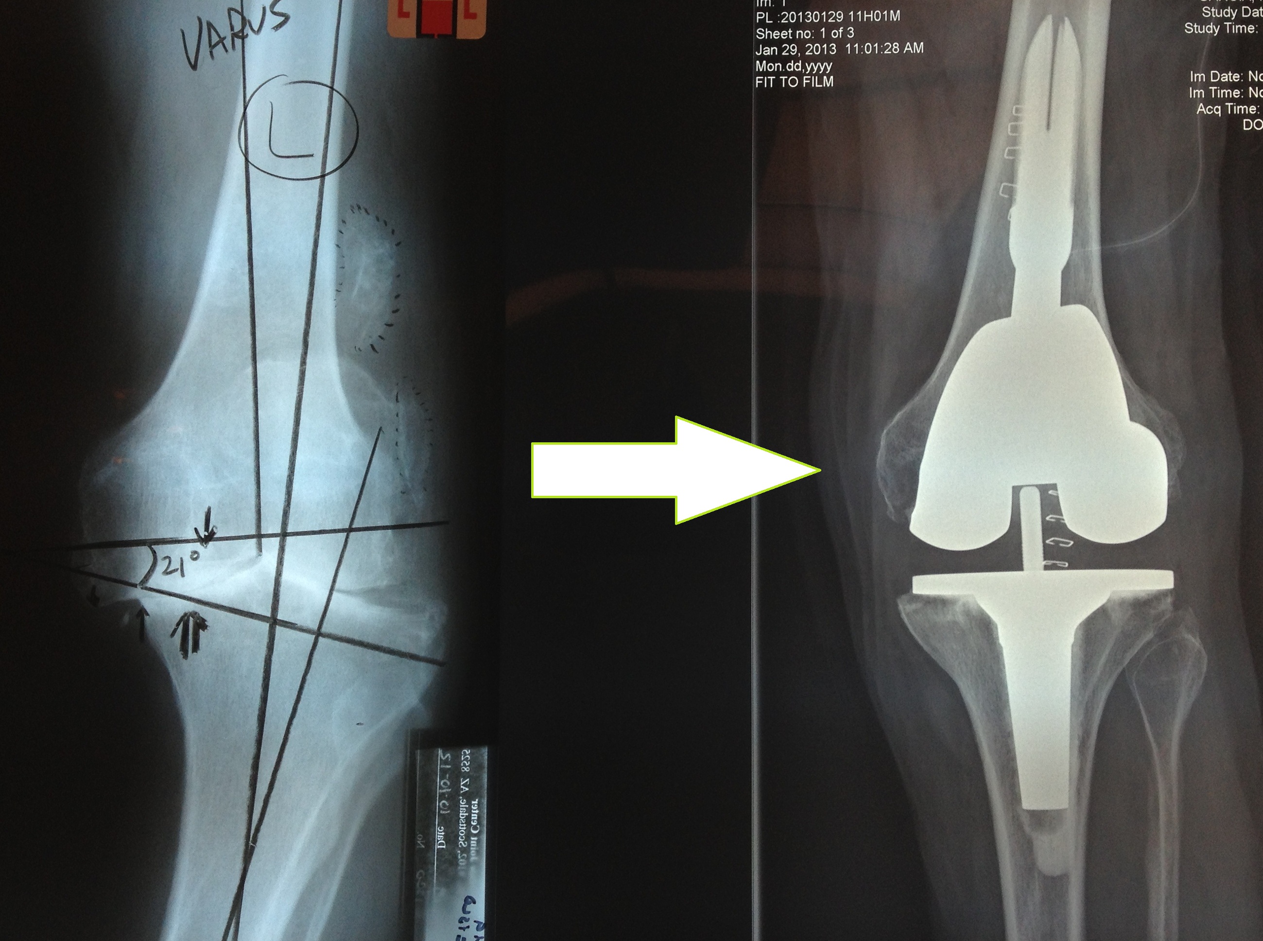 kneecap surgery