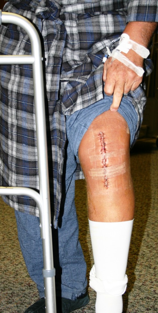 TKR Scar 2 Dr Stuart Kozinn MD TotalKnee Org Dr Stuart Kozinn