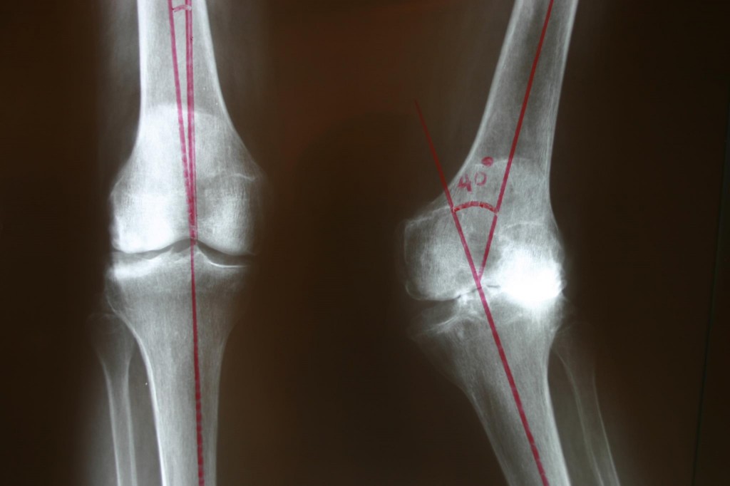 valgus knee - Dr. Stuart Kozinn, MD - TotalKnee.Org Dr. Stuart Kozinn ...