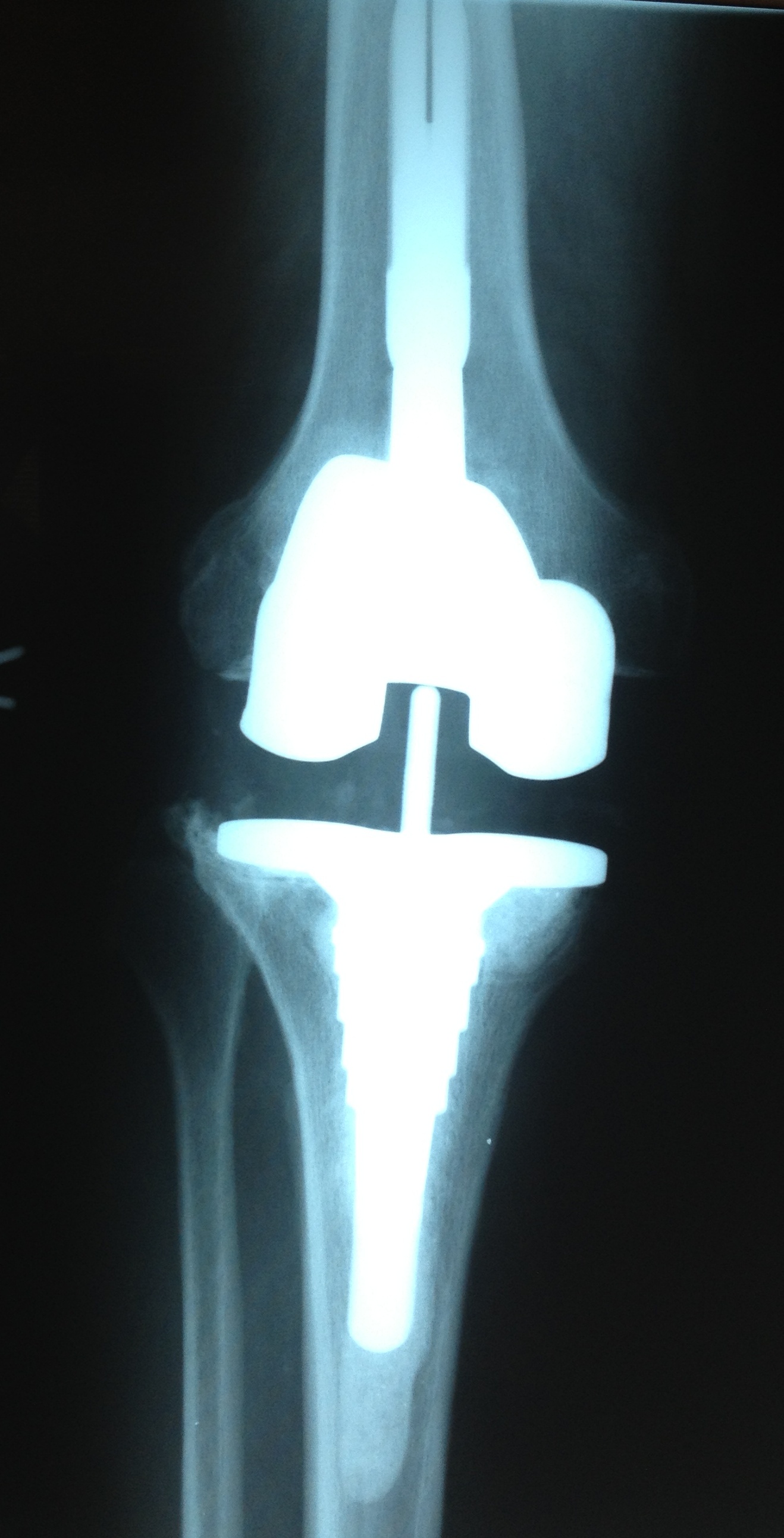 Revision Total Knee Replacement Dr Stuart Kozinn Md Totalkneeorg