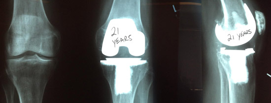 Dr. Kozinn has been doing total knees for 27 years. here is one that followed up after 21 years and is doing great!