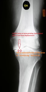 arthritic knee (2)