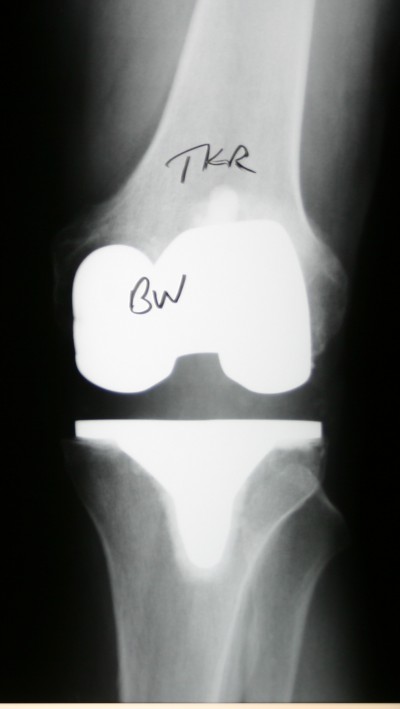 Rp Knee Xray Dr Stuart Kozinn Md Totalknee Org Dr Stuart Kozinn