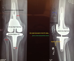 complex total knee : The good news is that total knees that do fail, can be re-done with good results.