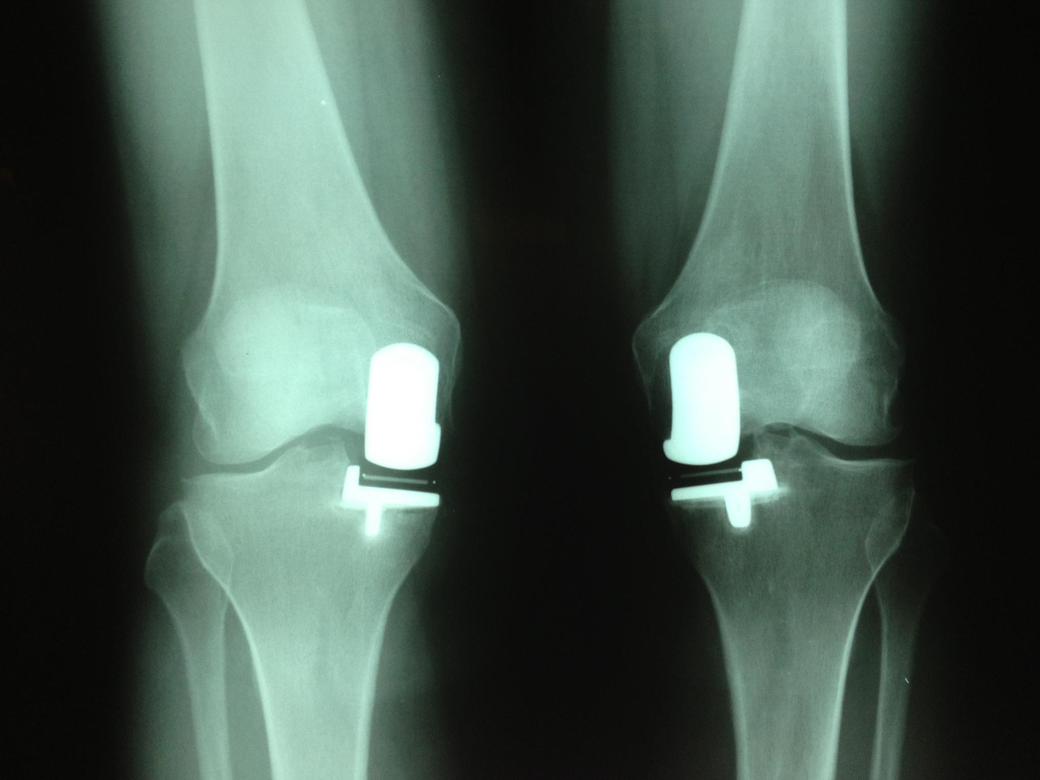 Diana gabaldon has "science fiction" new partial knee replacements!