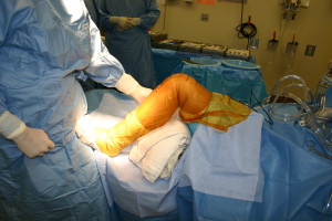 the knee is encased in antibiotic impregnated steriele plastic to protect against skin bacteria entering the wound.