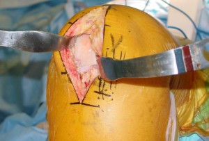 we can do our partial knee replacements without cutinng the quadiriceps muscle leading to a faster recovery