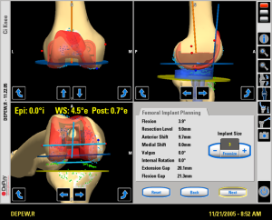 Computer navigation screen for total knee replacement.